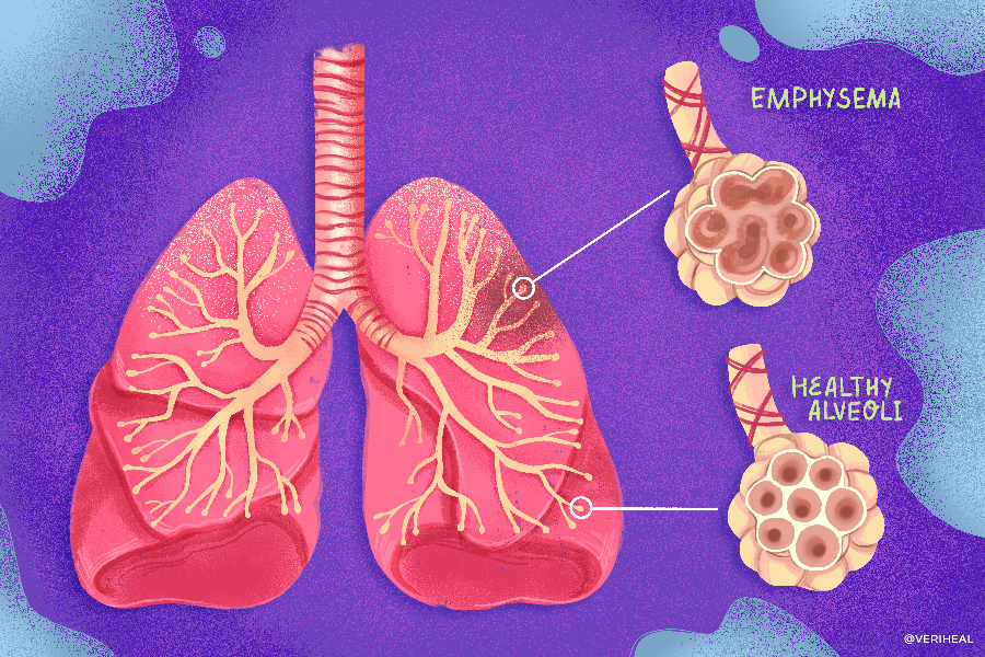 Emphysema