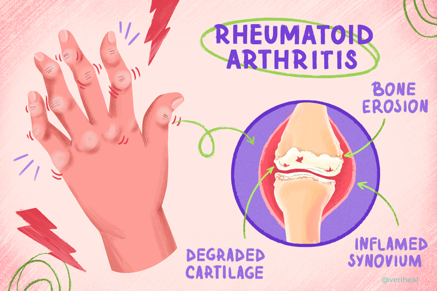 Rheumatoid_Arthritis
